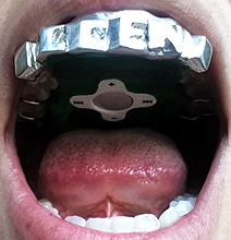 Tongue Controlled Mp3 Player Now Available Tongue Controlled Mp3 Player Now Available