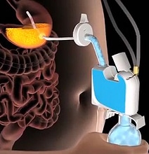 That’s One Way To Do It…Home Stomach Pumping Weight Loss Device