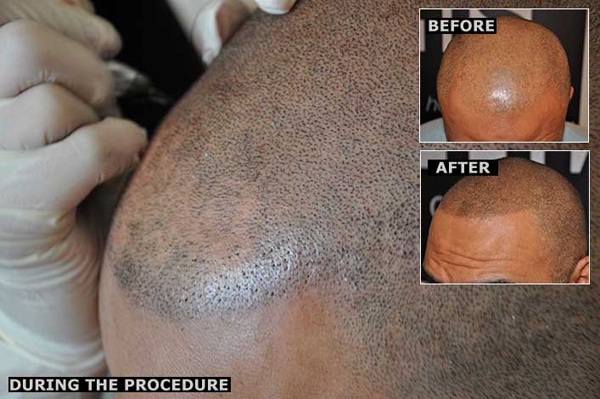 Baldness Solution With Tattoos