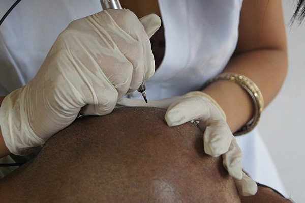 Baldness Solution With Tattoos