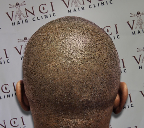 Baldness Solution With Tattoos 