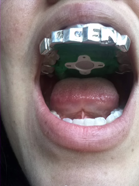 tongue-controlled-mp3-player tongue-controlled-mp3-player