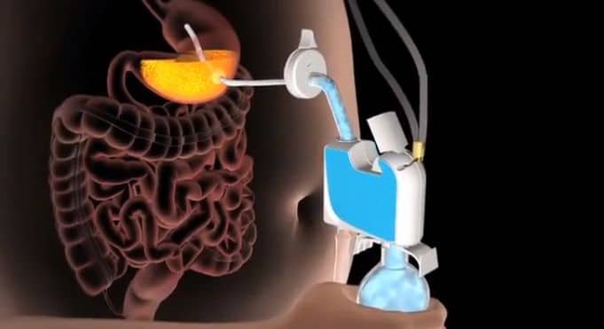 stomach-pumping-weight-loss-machine stomach-pumping-weight-loss-machine