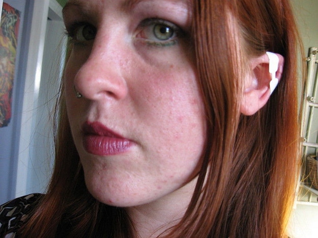Elven Ears Body Modification